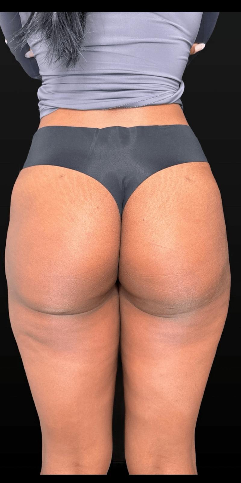 Alloclae Before & After Gallery - Patient 171338 - Image 2
