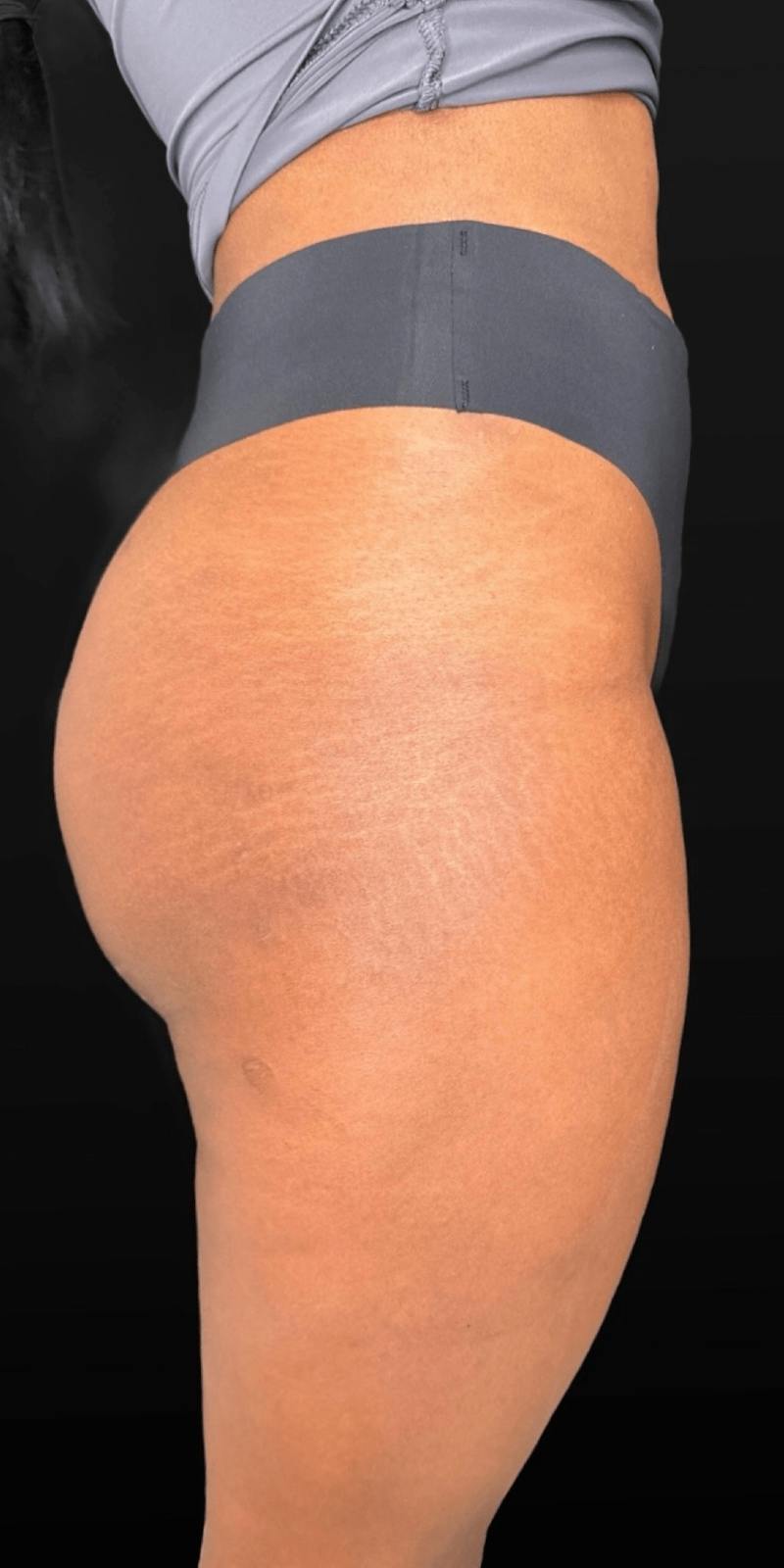 Alloclae Before & After Gallery - Patient 171338 - Image 4