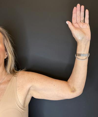 Arm Lift Before & After Gallery - Patient 991036 - Image 1