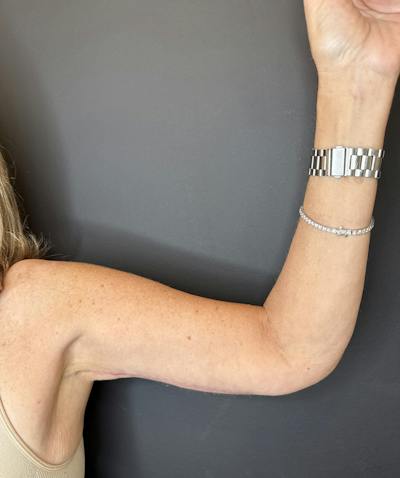 Arm Lift Before & After Gallery - Patient 991036 - Image 2