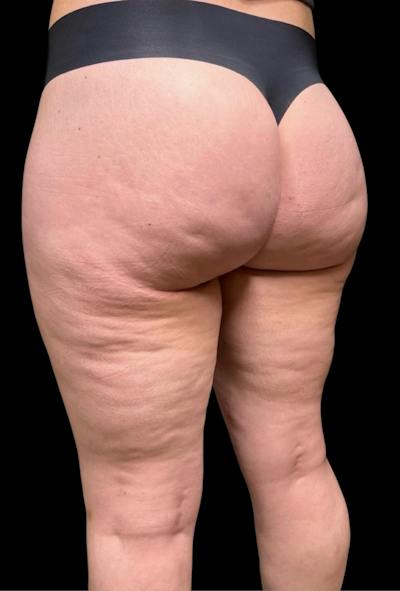 Aveli Cellulite Removal Before & After Gallery - Patient 275666 - Image 1