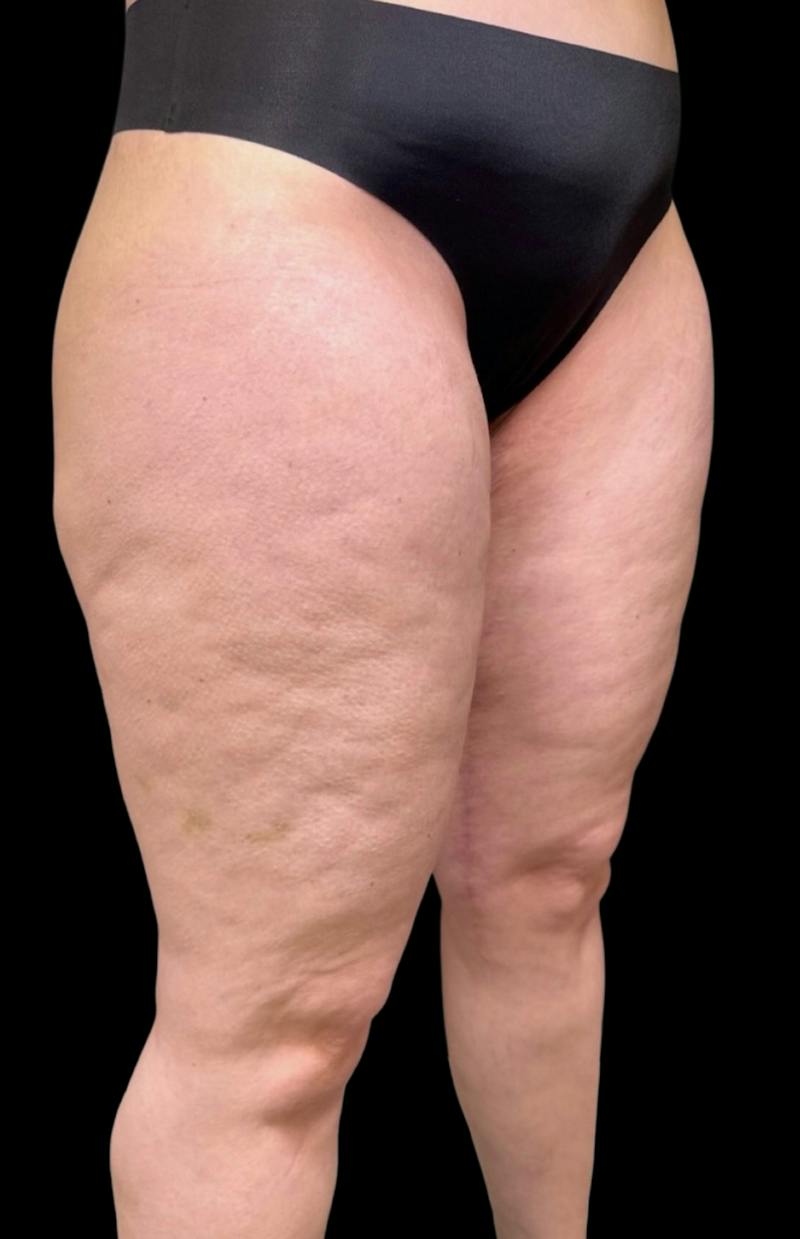 Aveli Cellulite Removal Before & After Gallery - Patient 275666 - Image 3