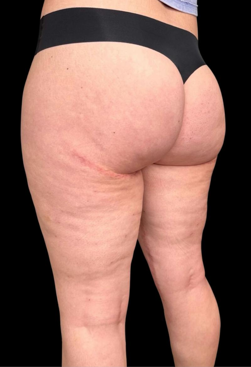 Aveli Cellulite Removal Before & After Gallery - Patient 275666 - Image 2