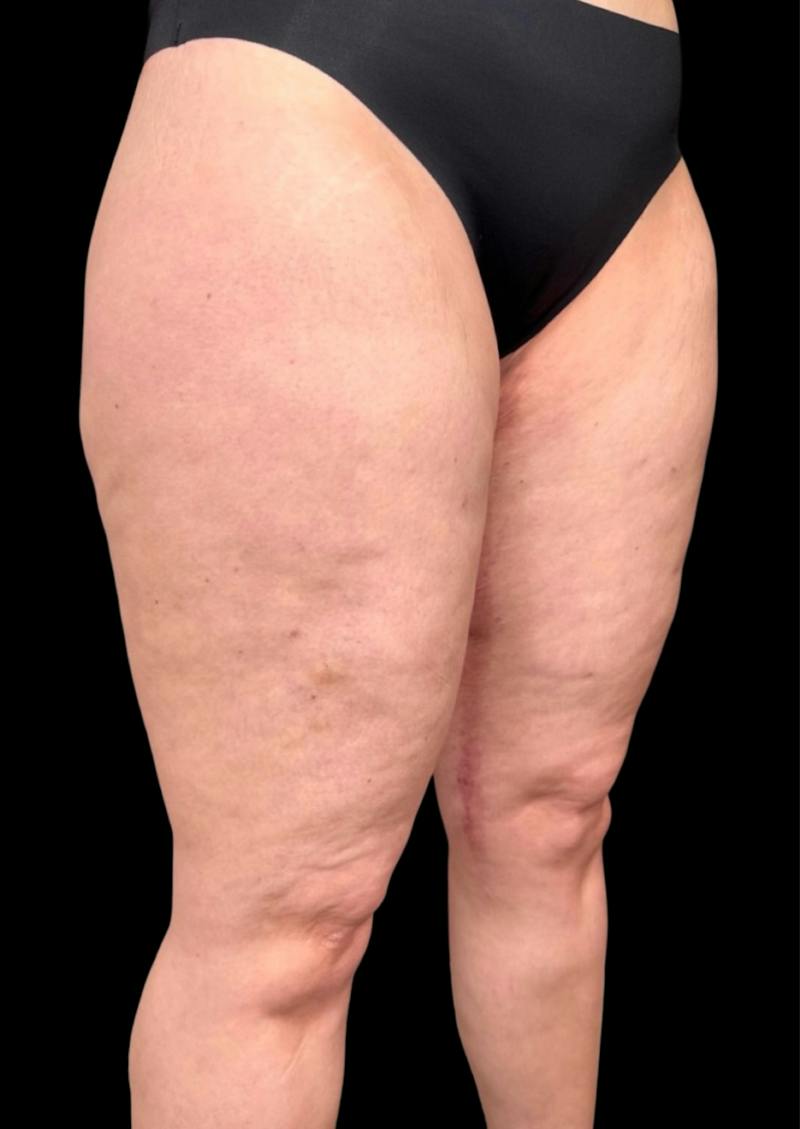 Aveli Cellulite Removal Before & After Gallery - Patient 275666 - Image 4