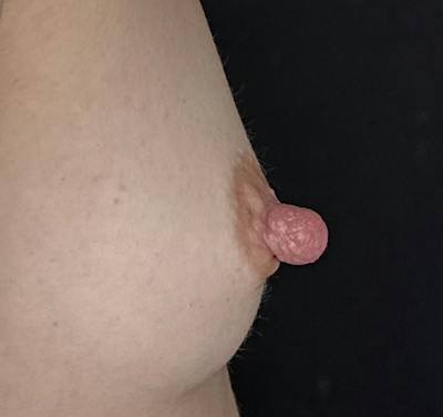 Nipple Reduction Before & After Gallery - Patient 325091 - Image 1