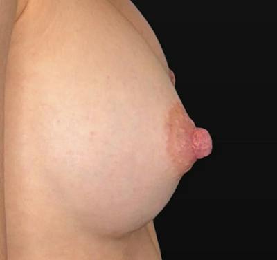 Nipple Reduction Before & After Gallery - Patient 325091 - Image 2