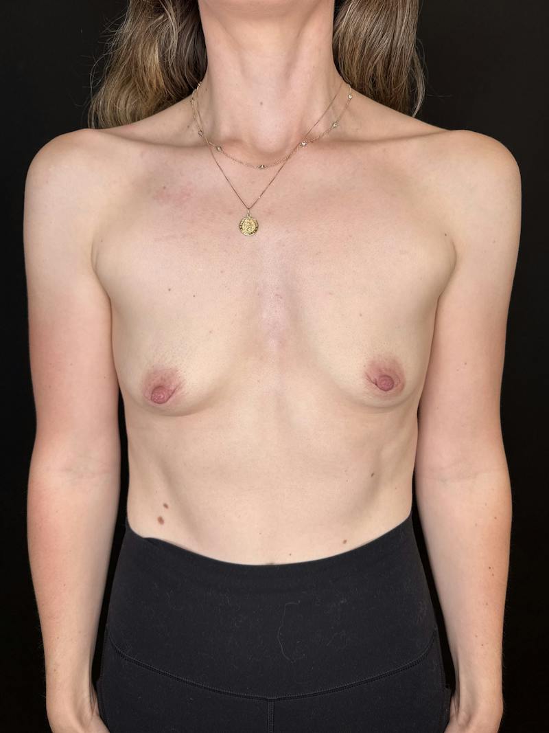 Breast Augmentation Before & After Gallery - Patient 202236 - Image 1