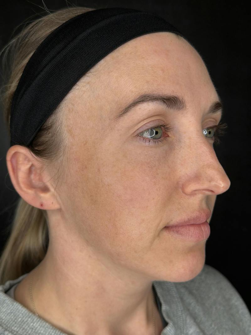 Upper + Lower Blepharoplasty Before & After Gallery - Patient 328646 - Image 1