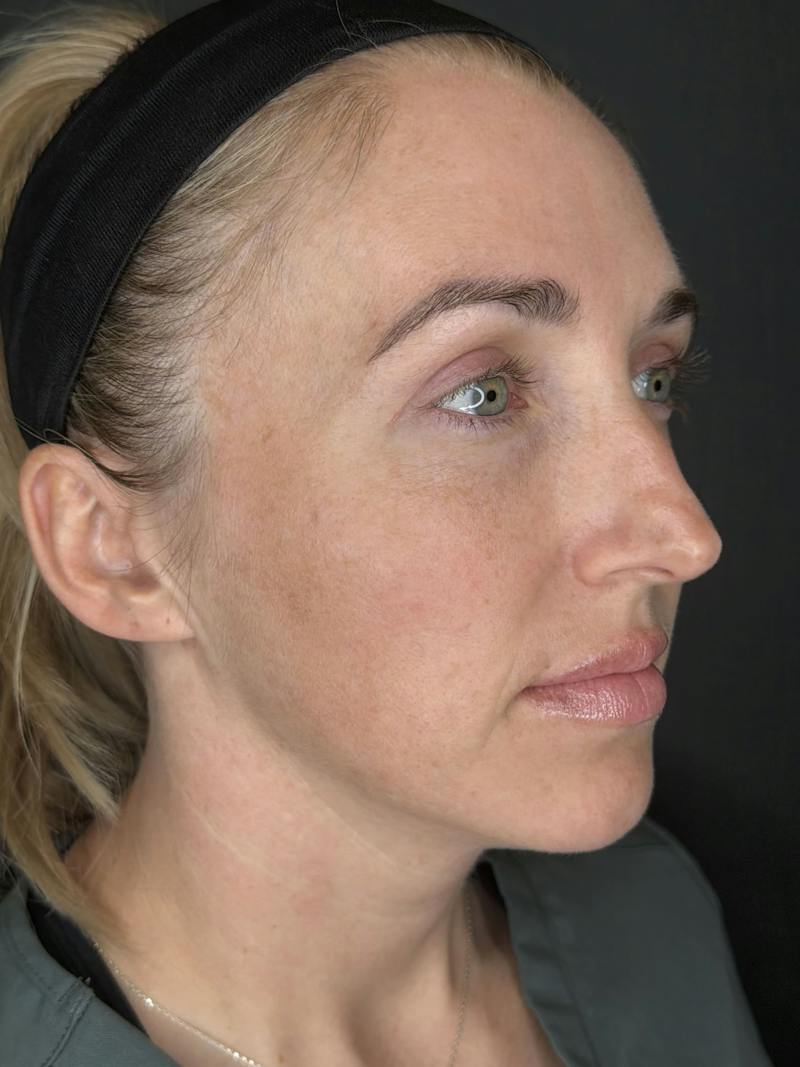 Upper + Lower Blepharoplasty Before & After Gallery - Patient 328646 - Image 2