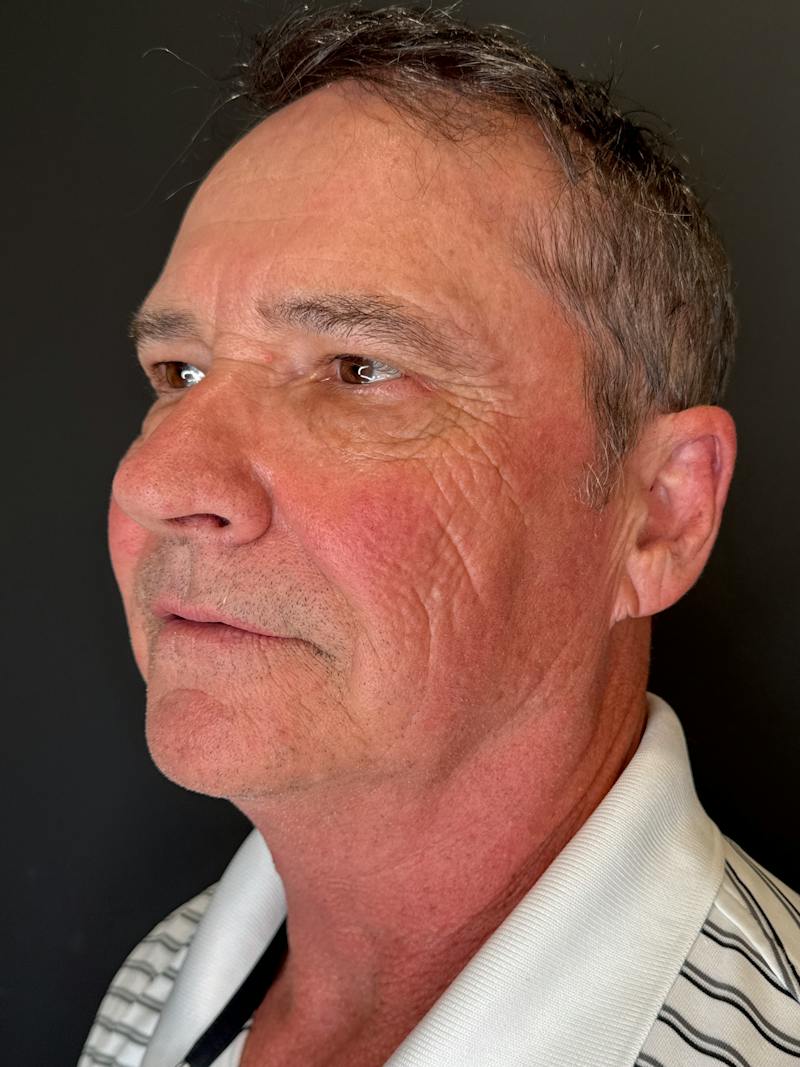Upper + Lower Blepharoplasty Before & After Gallery - Patient 333900 - Image 1