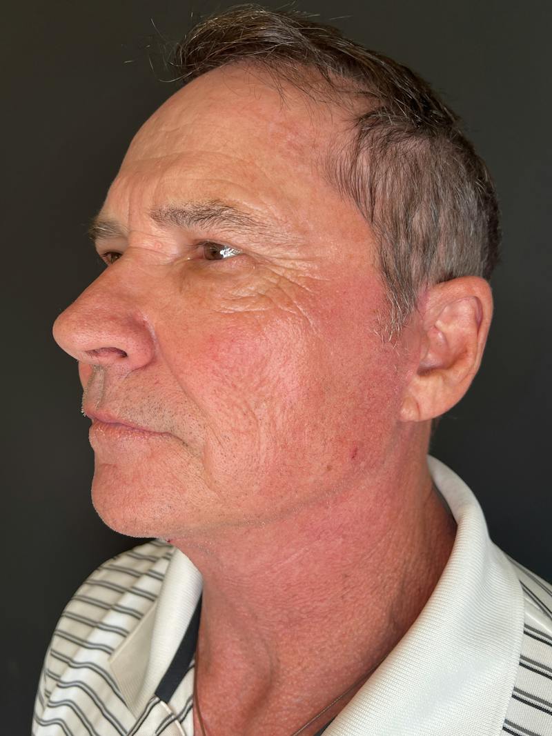 Upper + Lower Blepharoplasty Before & After Gallery - Patient 333900 - Image 2