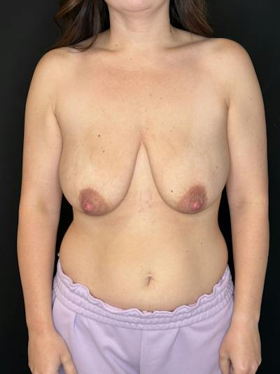 Breast Lift w/ Augmentation Before & After Gallery - Patient 810791 - Image 1