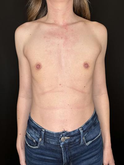 Breast Augmentation Before & After Gallery - Patient 340598 - Image 1