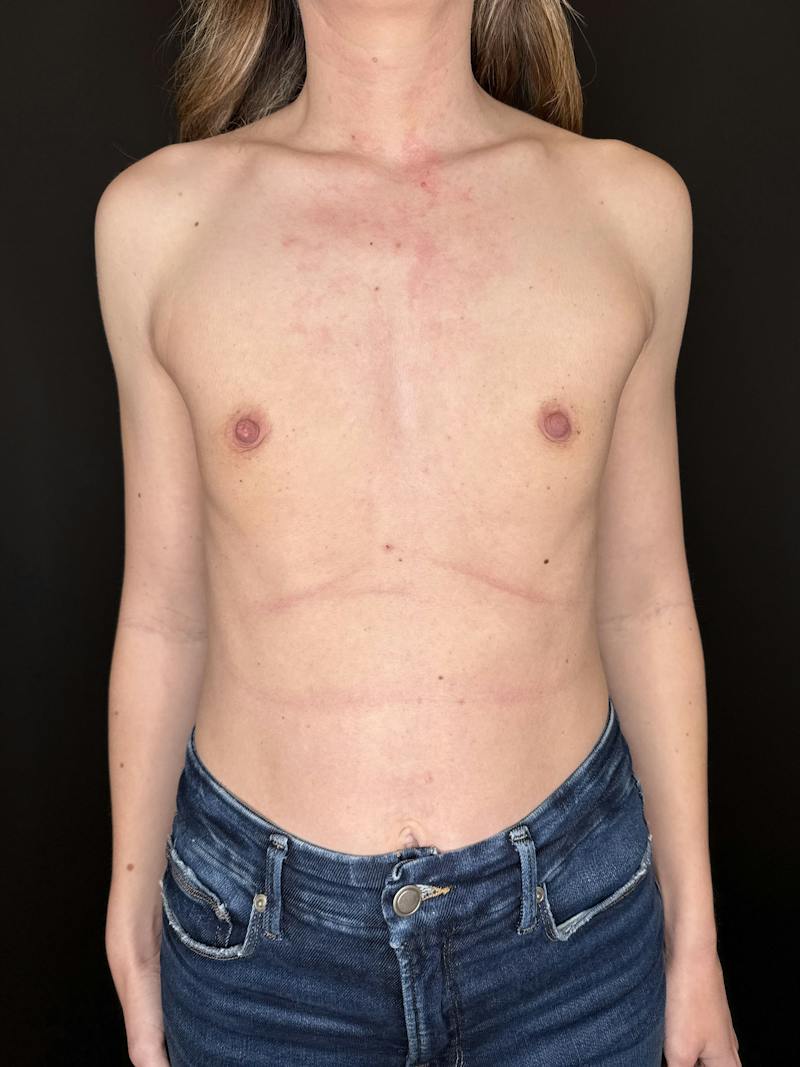 Breast Augmentation Before & After Gallery - Patient 340598 - Image 1