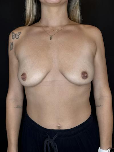 Breast Lift w/ Augmentation Before & After Gallery - Patient 379654 - Image 1