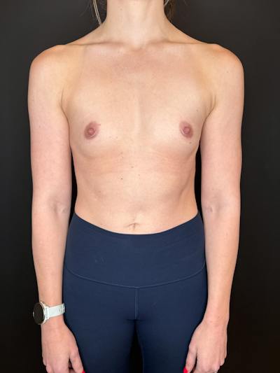 Breast Augmentation Before & After Gallery - Patient 170091 - Image 1