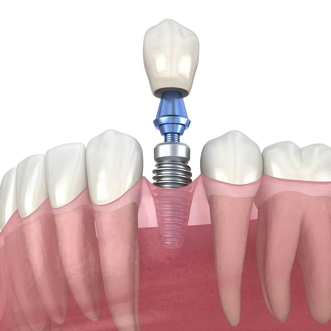 tooth implant infographic