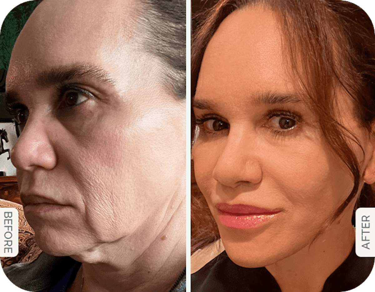Miami Facelift Before & After Gallery - Patient 241547 - Image 1 - The Chopra Plastic Surgery Center