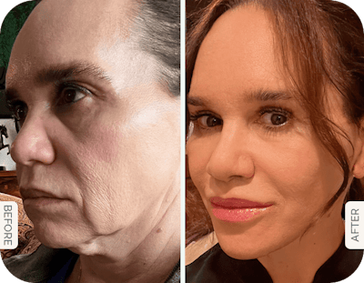 Miami Neck Lift Before & After Gallery - Patient 260471 - Image 1 - The Chopra Plastic Surgery Center