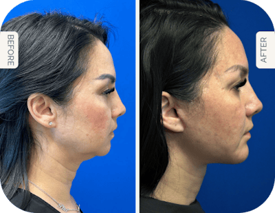 Miami Neck Lift Before & After Gallery - Patient 253946 - Image 1 - The Chopra Plastic Surgery Center