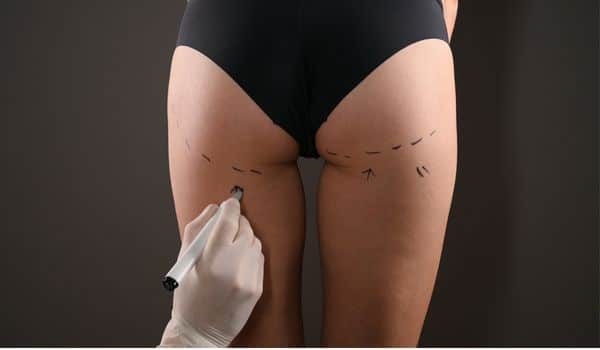 Brazilian butt lift