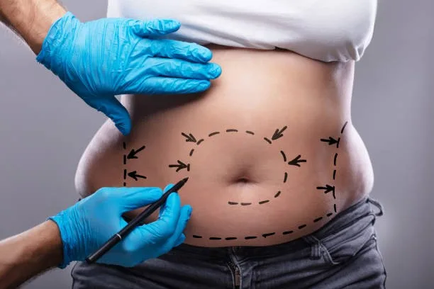 Drainless Tummy Tuck jpg