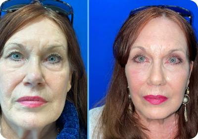 Miami Revision Blepharoplasty Before & After Gallery - Patient 278596 - Image 1 - The Chopra Plastic Surgery Center