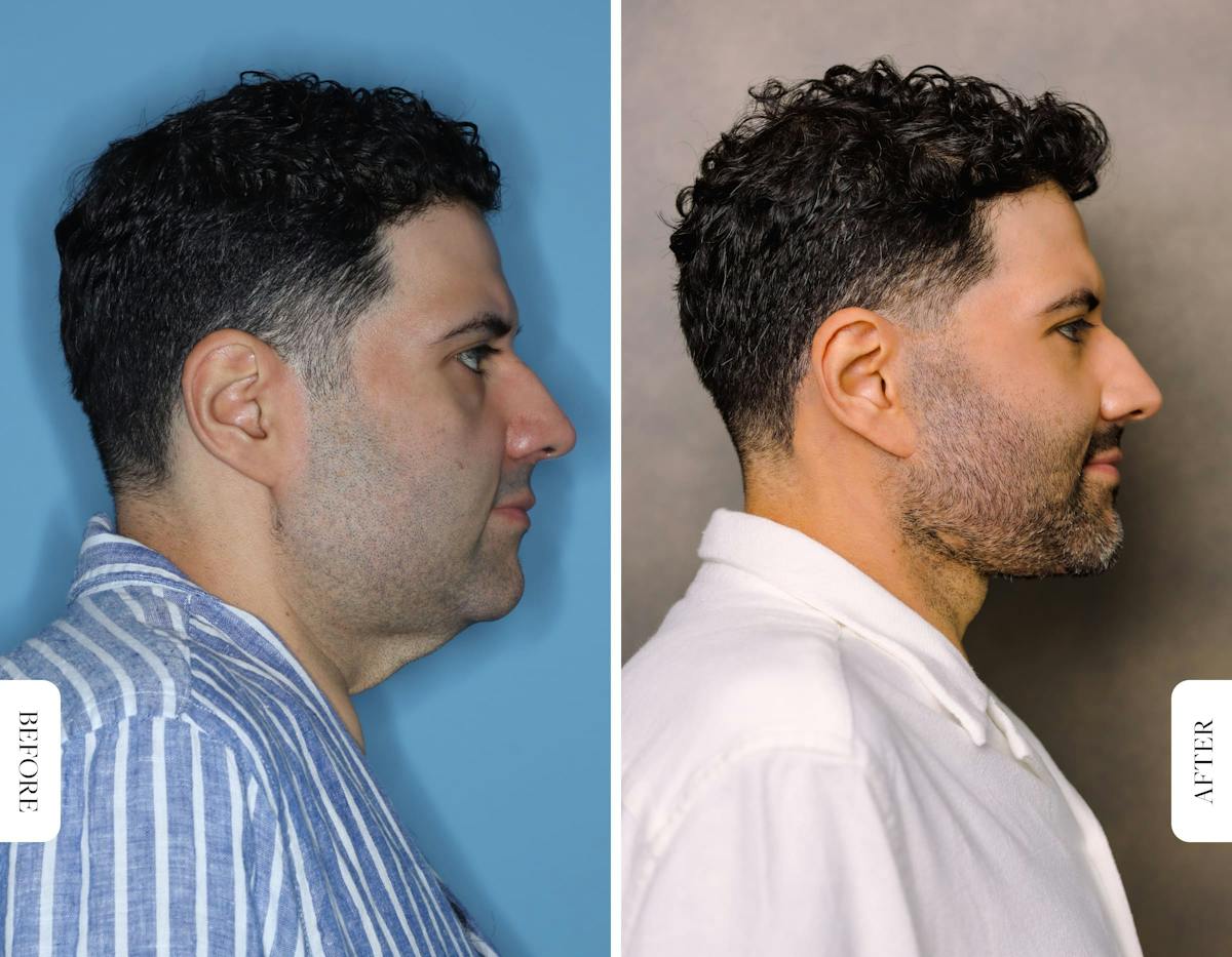Miami Facial Fat Grafting Before & After Gallery - Patient 298029 - Image 3 - The Chopra Plastic Surgery Center