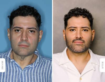 Miami Facial Fat Grafting Before & After Gallery - Patient 298029 - Image 1 - The Chopra Plastic Surgery Center