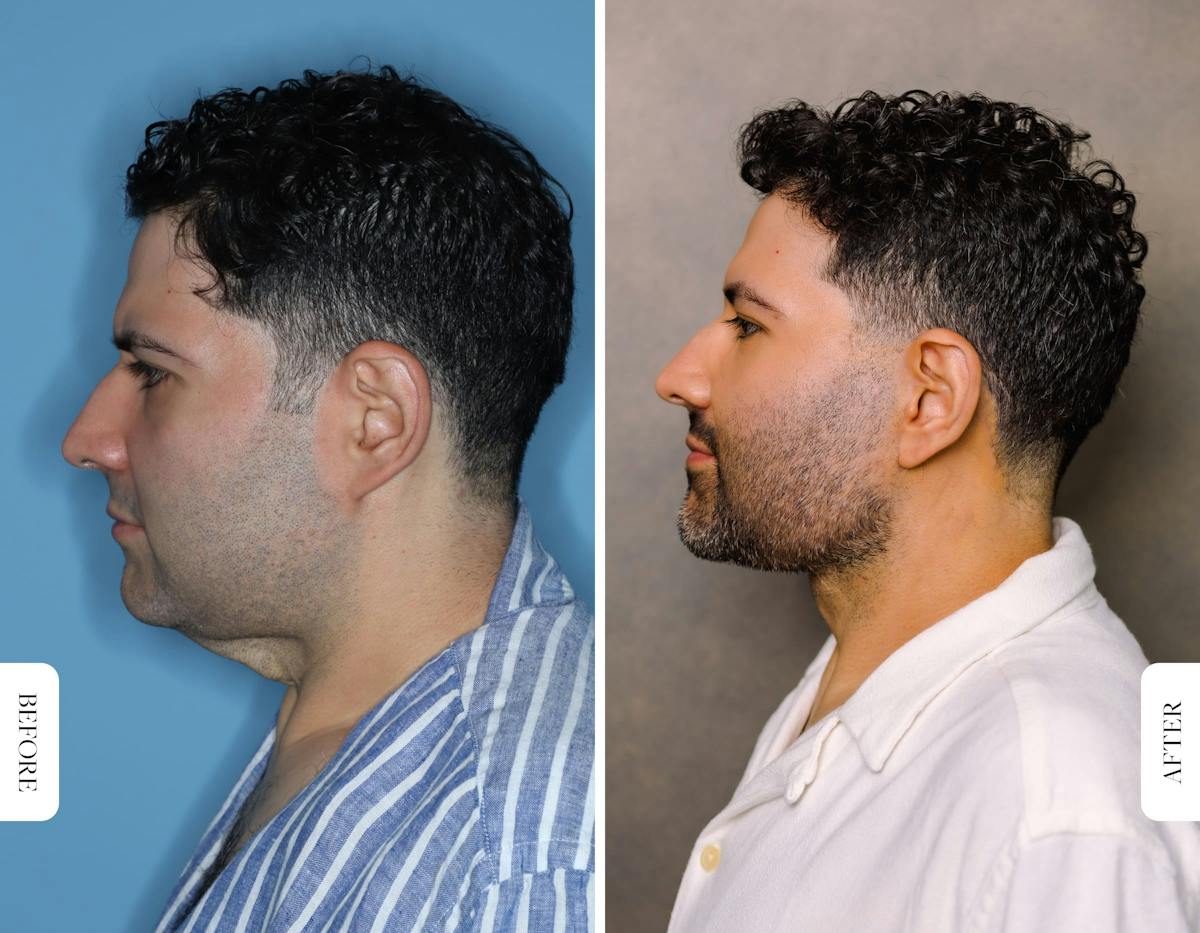 Miami Facial Fat Grafting Before & After Gallery - Patient 298029 - Image 2 - The Chopra Plastic Surgery Center