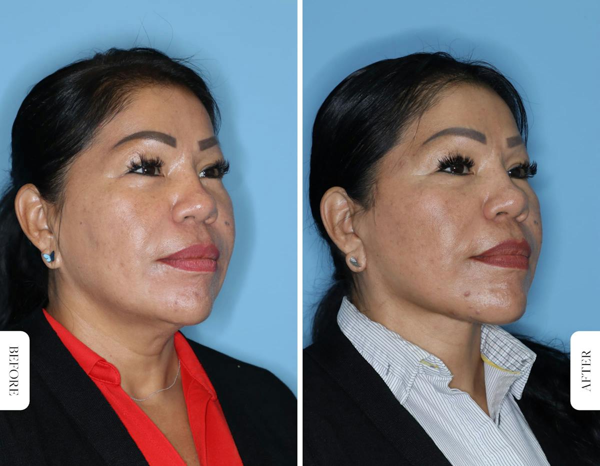 Miami Facelift Before & After Gallery - Patient 681237 - Image 4 - The Chopra Plastic Surgery Center