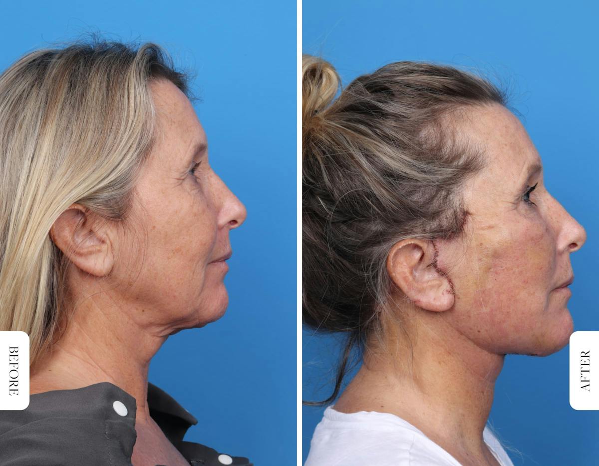 Miami Facelift Before & After Gallery - Patient 160708 - Image 2 - The Chopra Plastic Surgery Center