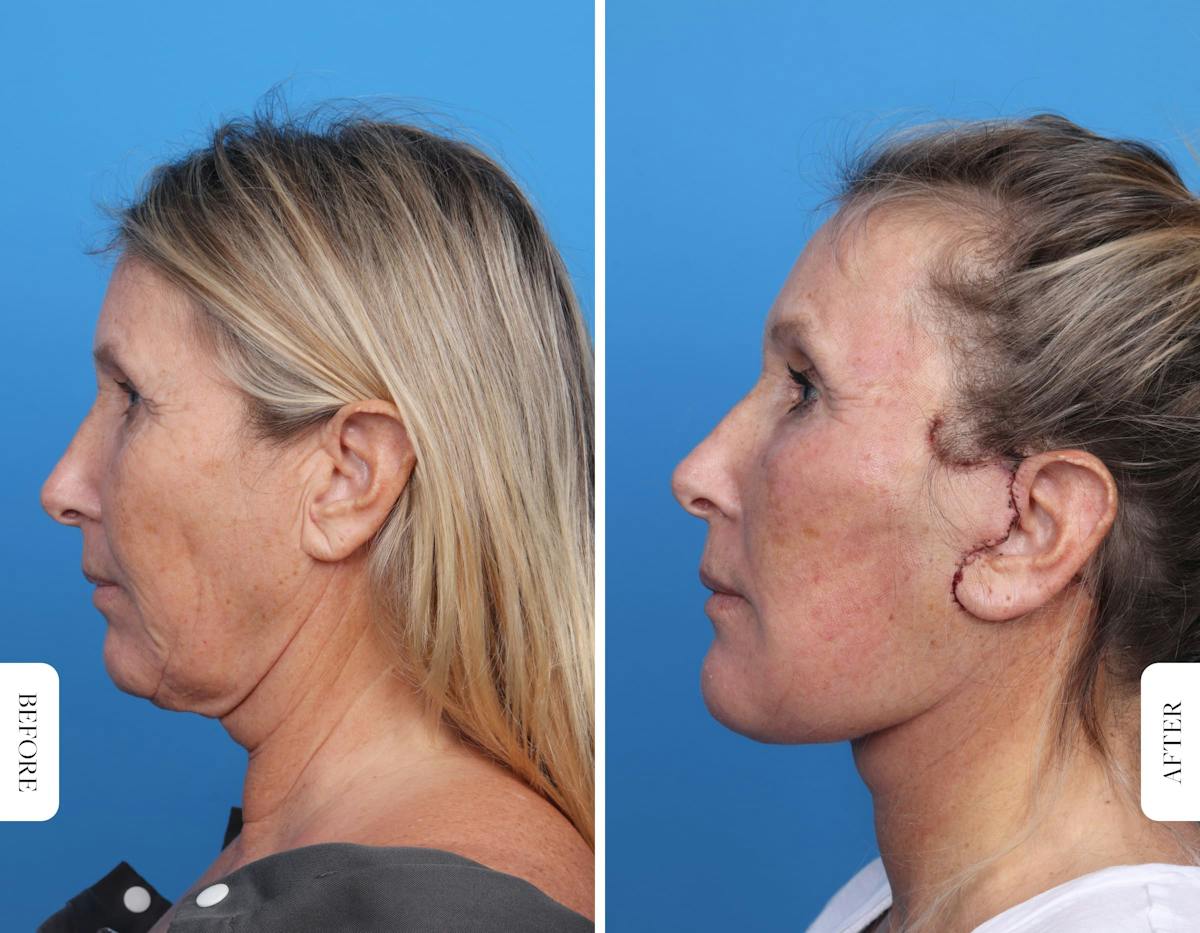 Miami Facelift Before & After Gallery - Patient 160708 - Image 4 - The Chopra Plastic Surgery Center