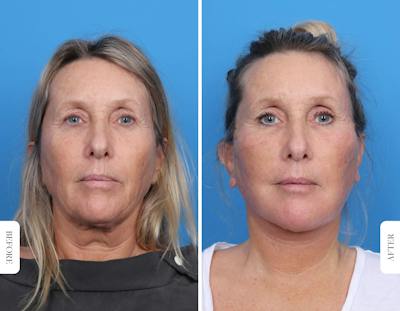 Miami Facelift Before & After Gallery - Patient 160708 - Image 1 - The Chopra Plastic Surgery Center
