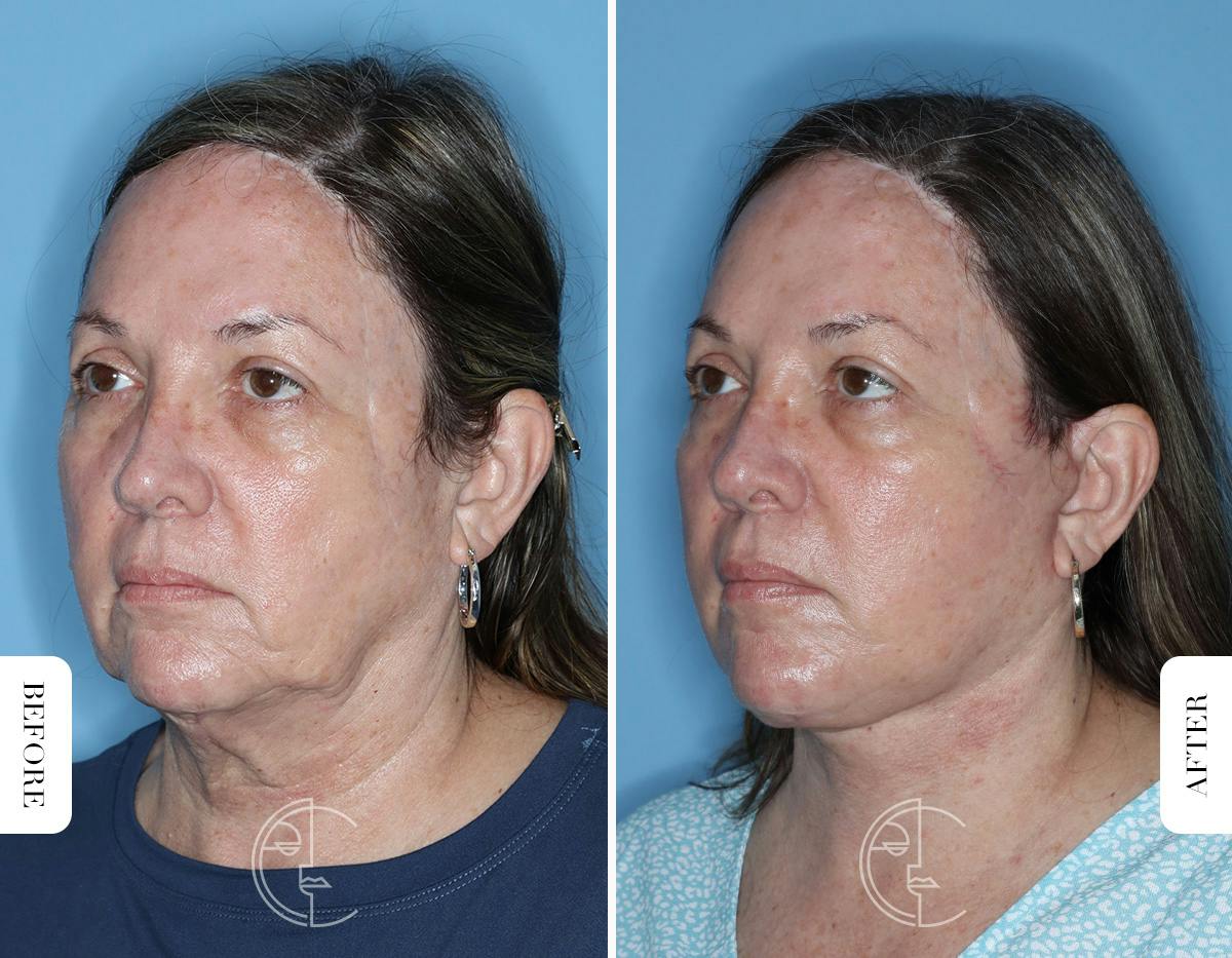 Miami Facelift Before & After Gallery - Patient 122034 - Image 4 - The Chopra Plastic Surgery Center