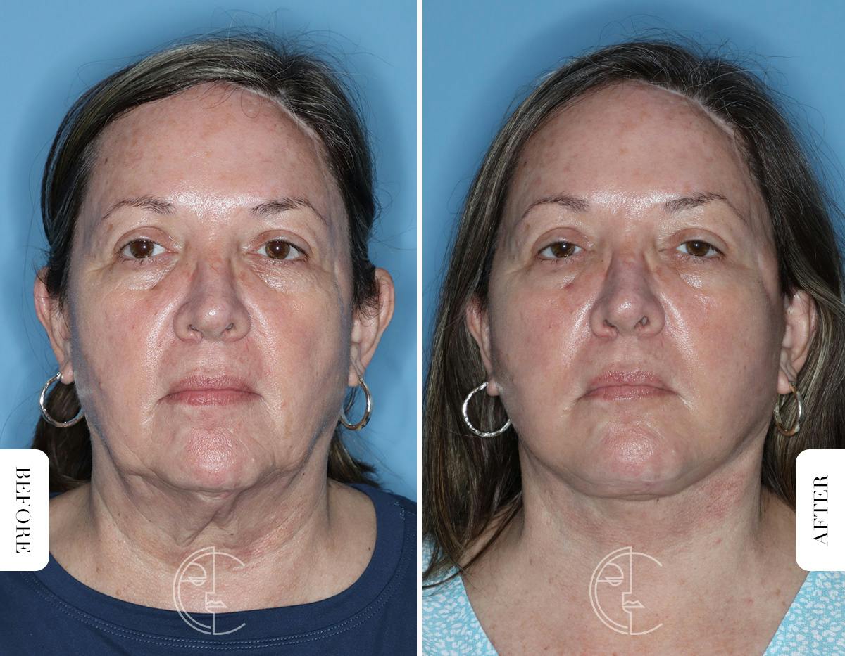 Miami Facelift Before & After Gallery - Patient 122034 - Image 1 - The Chopra Plastic Surgery Center