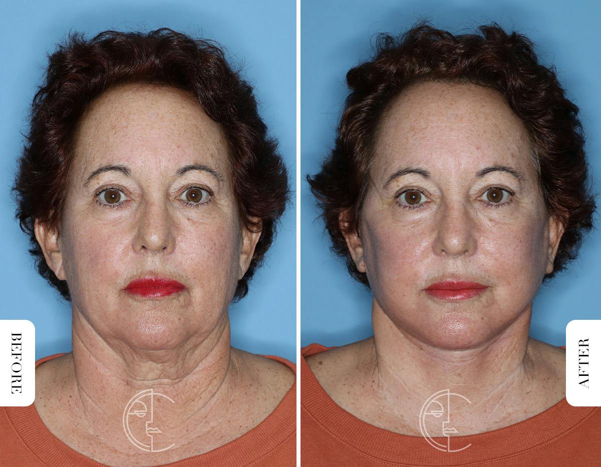 Miami Facelift Before & After Gallery - Patient 281990 - Image 1 - The Chopra Plastic Surgery Center