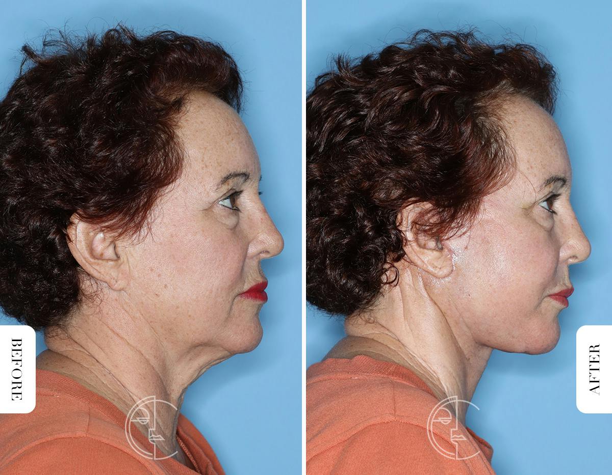 Miami Facelift Before & After Gallery - Patient 281990 - Image 3 - The Chopra Plastic Surgery Center