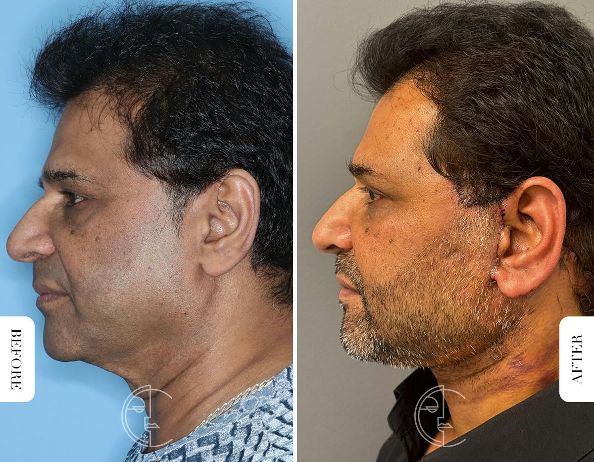 Miami Male Facelift Before & After Gallery - Patient 180644 - Image 3 - The Chopra Plastic Surgery Center