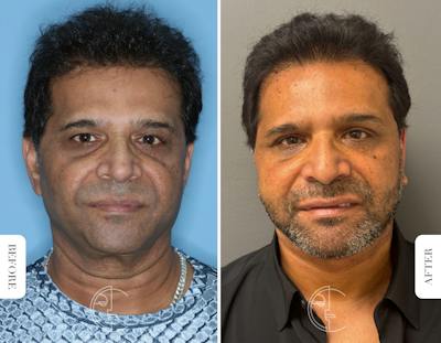 Miami Male Facelift Before & After Gallery - Patient 180644 - Image 1 - The Chopra Plastic Surgery Center