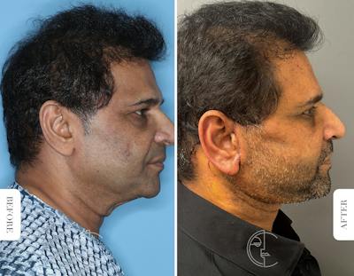 Miami Male Neck Lift Before & After Gallery - Patient 413595 - Image 1 - The Chopra Plastic Surgery Center