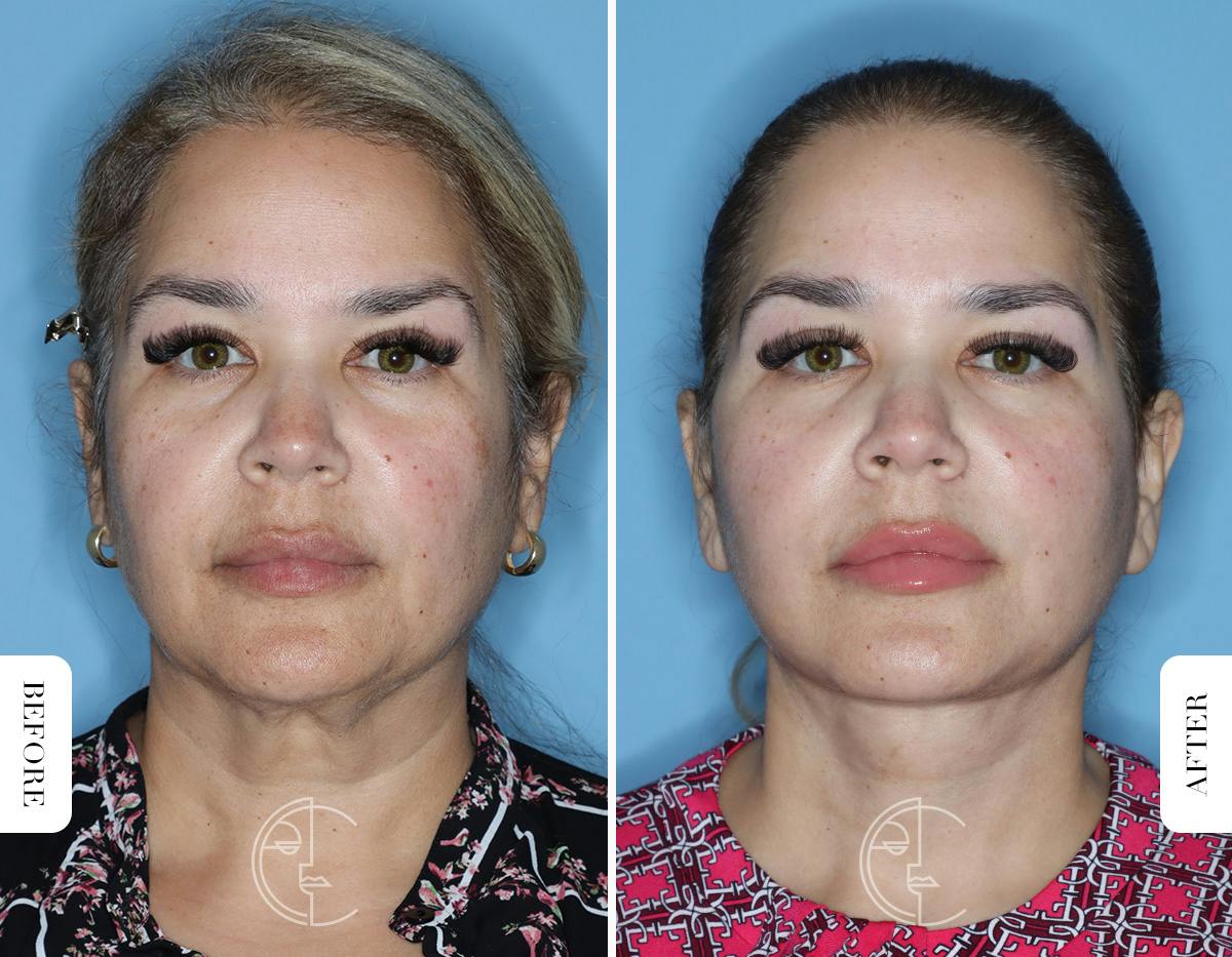 Miami Facelift Before & After Gallery - Patient 754729 - Image 1 - The Chopra Plastic Surgery Center