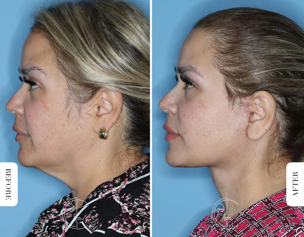 Miami Facelift Before & After Gallery - Patient 754729 - Image 5 - The Chopra Plastic Surgery Center