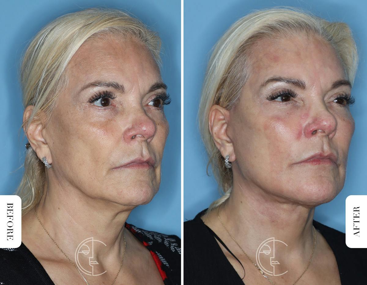 Miami Revision Facelift & Neck Lift Before & After Gallery - Patient 171962 - Image 2 - The Chopra Plastic Surgery Center