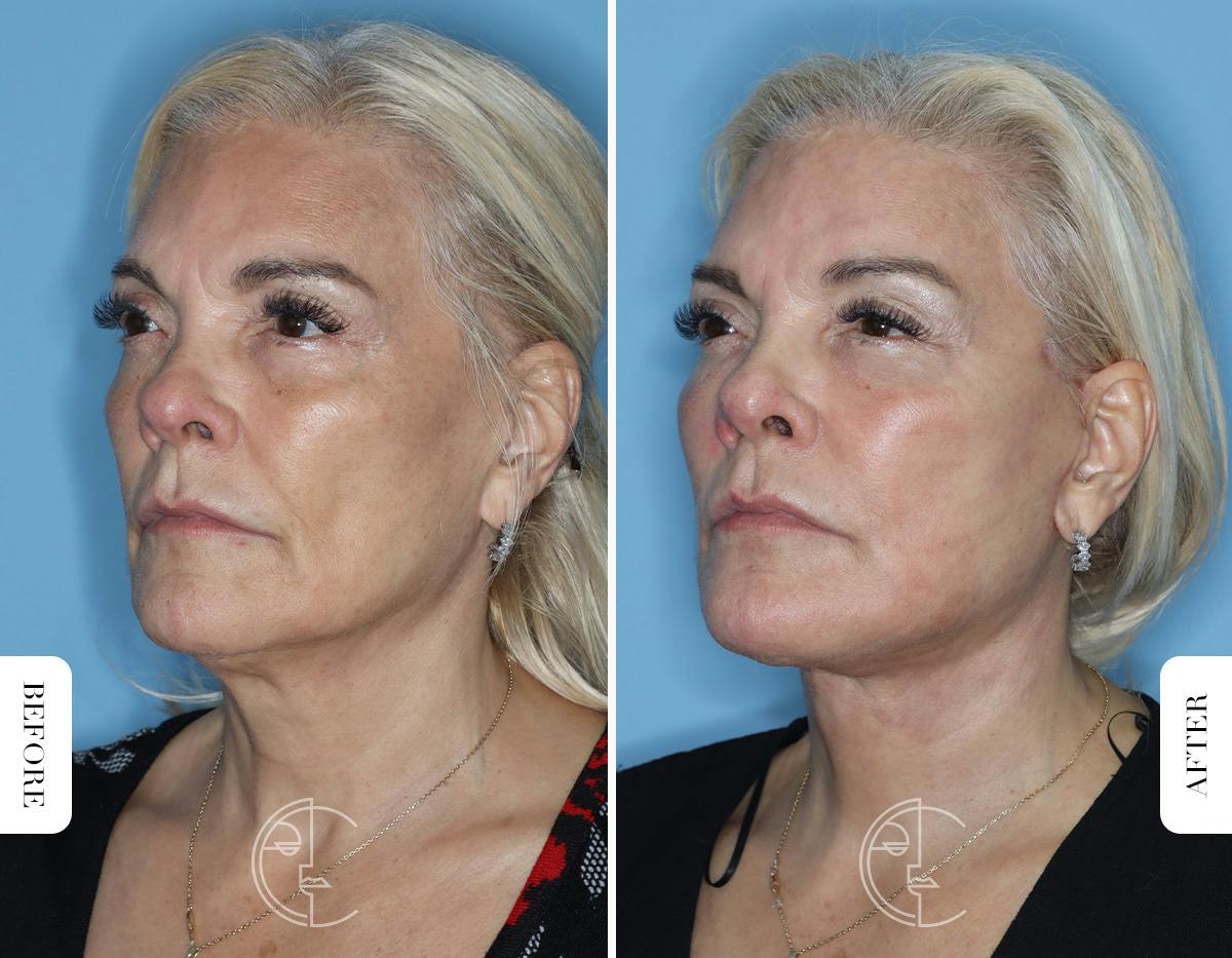 Miami Revision Facelift & Neck Lift Before & After Gallery - Patient 171962 - Image 4 - The Chopra Plastic Surgery Center