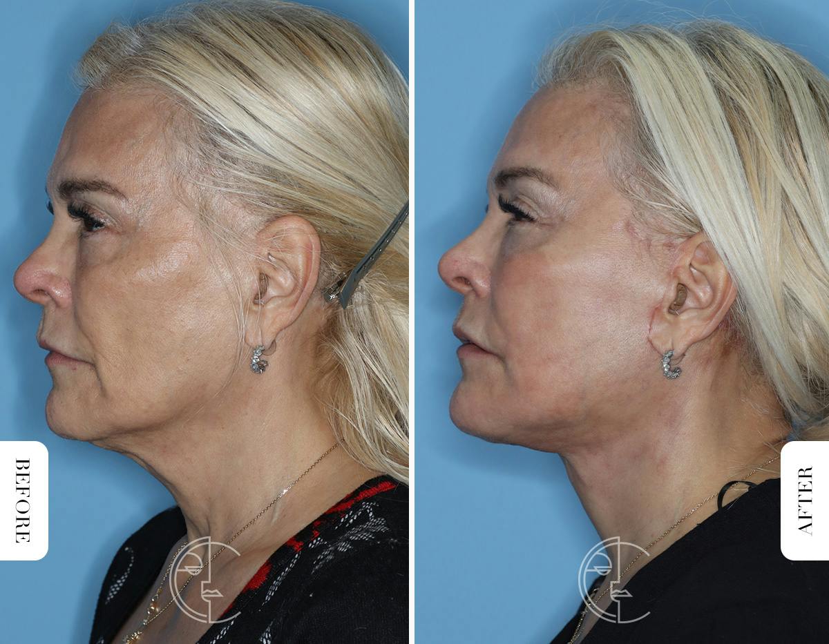 Miami Revision Facelift & Neck Lift Before & After Gallery - Patient 171962 - Image 5 - The Chopra Plastic Surgery Center