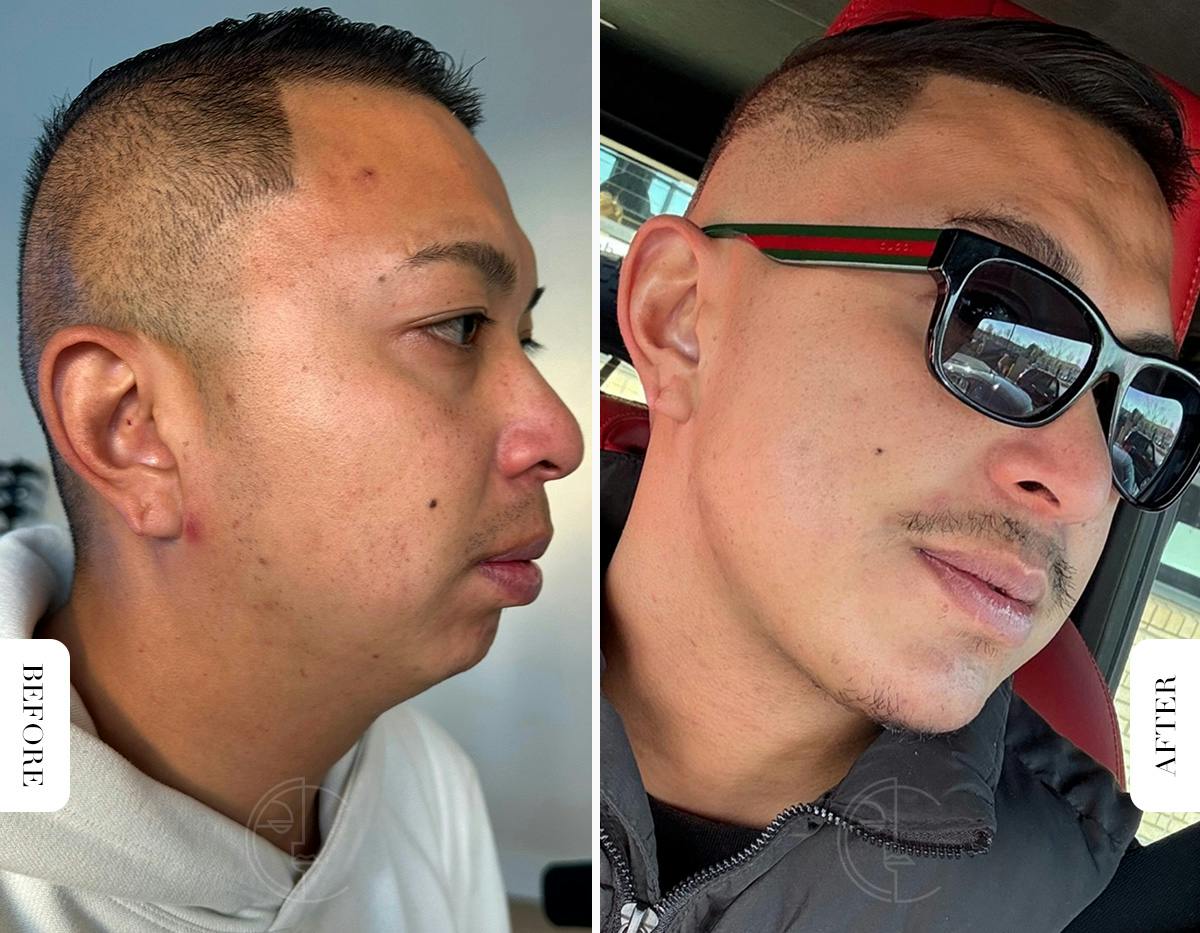 Miami Chin Augmentation Before & After Gallery - Patient 220368 - Image 1 - The Chopra Plastic Surgery Center