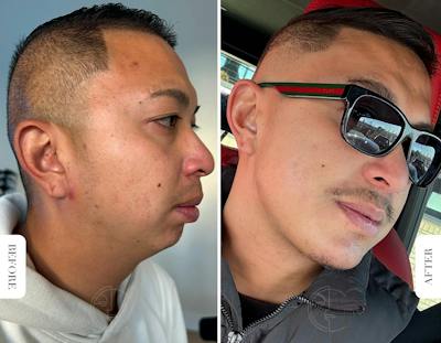 Miami Chin Augmentation Before & After Gallery - Patient 220368 - Image 1 - The Chopra Plastic Surgery Center