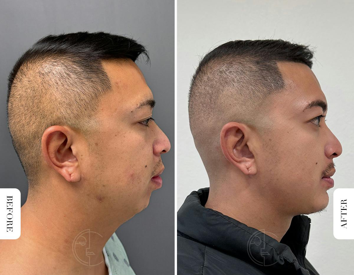 Miami Chin Augmentation Before & After Gallery - Patient 220368 - Image 2 - The Chopra Plastic Surgery Center