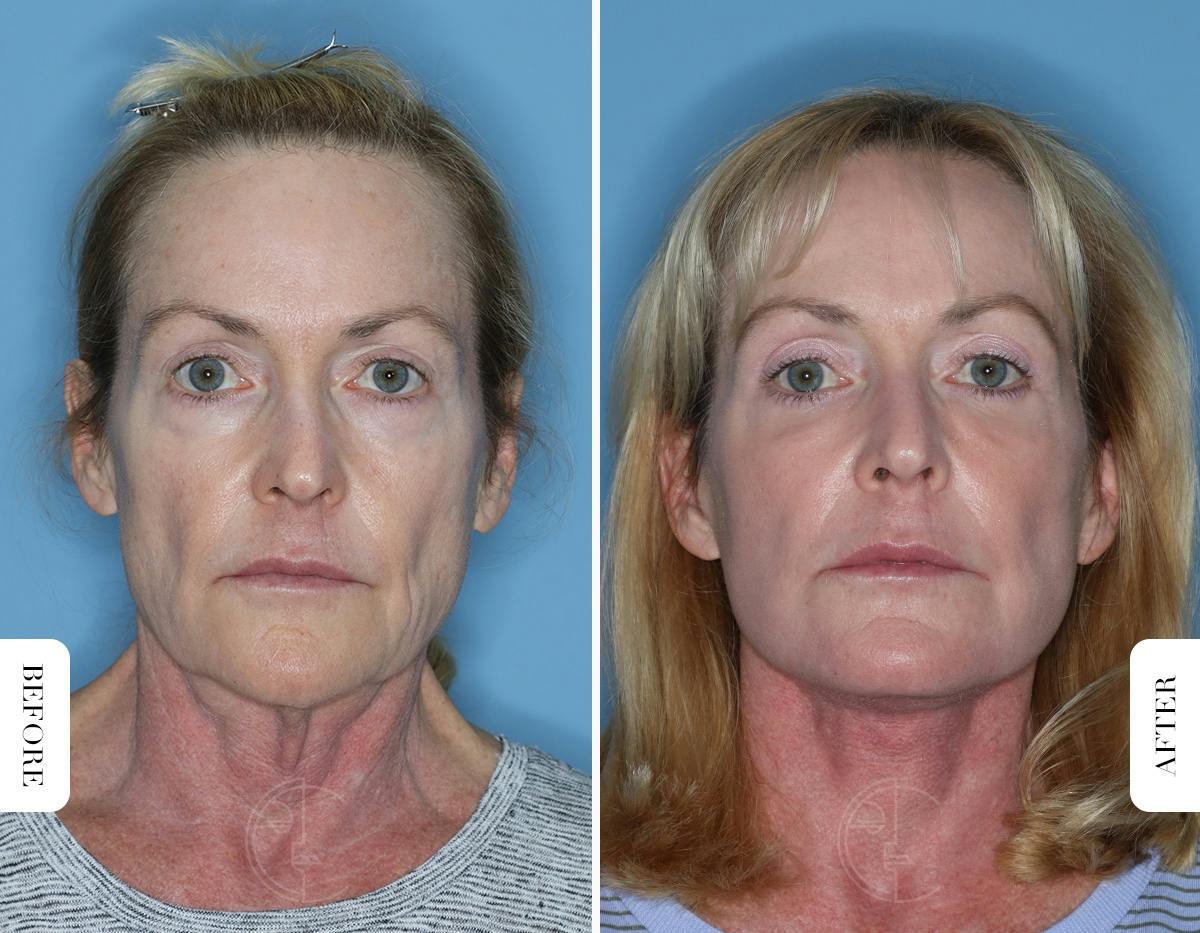Miami Lower Eyelid Lift Before & After Gallery - Patient 322158 - Image 1 - The Chopra Plastic Surgery Center